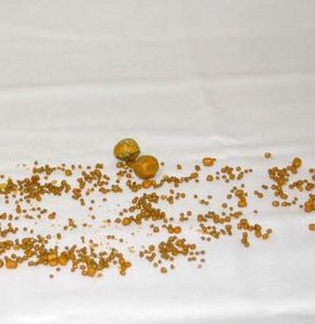 Safra kesesinden 8 bin 422 tane taş çıktı!