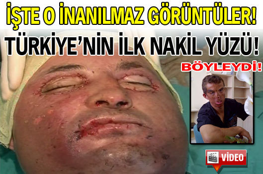 Türkiye’nin ilk nakil yüzü! VİDEO