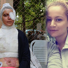 Kocasının kezzapla yaktığı Zehra Elber yardım bekliyor