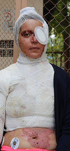 Kocasının kezzapla yaktığı Zehra Elber yardım bekliyor