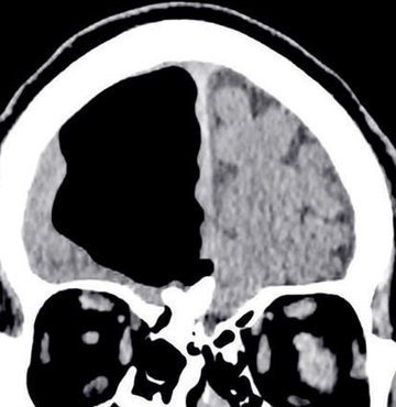 İrlanda’da fiziksel denge bozukluğu şikâyetiyle hastaneye başvuran hastanın yapılan bilgisayarlı beyin taramaları sonucunda, beyninde sağ frontal lobun olması gereken yerde 9 santimlik bir hava boşluğu tespit edildi