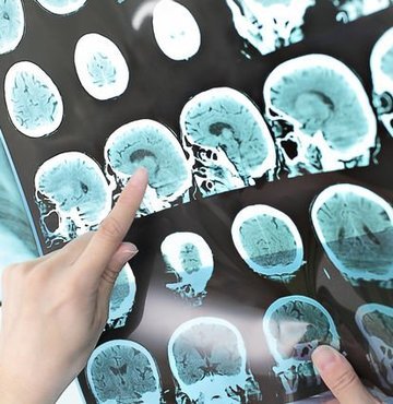 Bilim insanları, ilk kez hayvanlar üzerinde denenen bir ilacın Alzheimer hastalarının beynindeki ikinci önemli lezyon tau patolojisini giderdiğini bildirdi