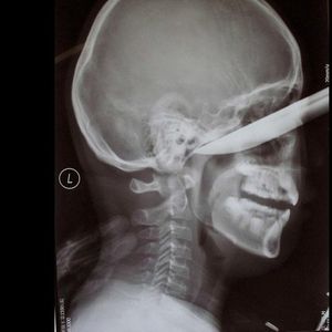 RÖNTGEN FİLMLERİNDEKİ AKIL ALMAZ GÖRÜNTÜLER