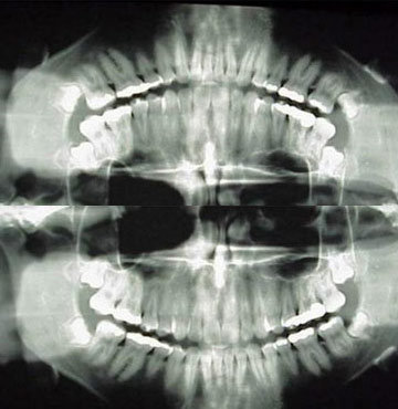 Diş röntgenindeki büyük tehlike!