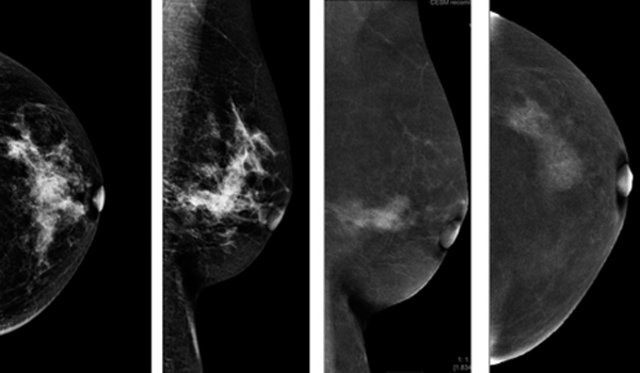 Маммография в московском. Контрастная спектральная маммография. Двухэнергетическая маммография. Двуэнергетическая контрастная спектральная маммография (Cesm).