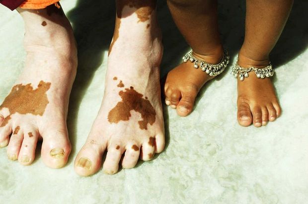 Yeni bulgular, vitiligo tedavisine umut oldu