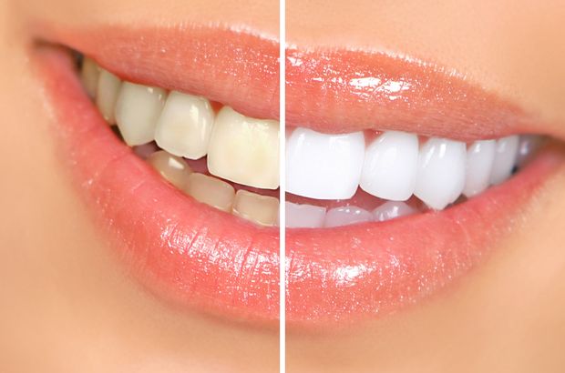 Diş beyazlatma hekim kontrolünde yapılmalı
