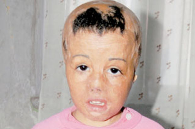 Suriyeli minik Evin’e yüz ve saç nakli yapılacak