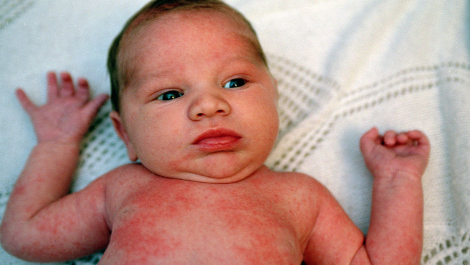 Çocuklarda alerji testleri Sağlık Haberleri