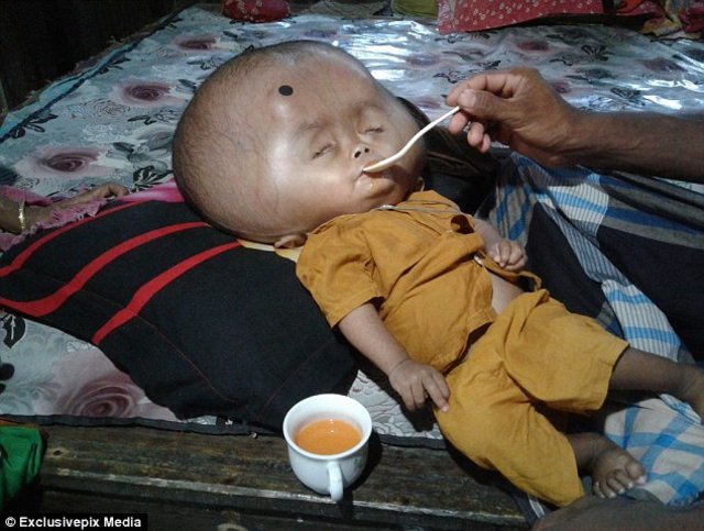 Bangladeş'te yaşayan minik Emon'un kafası tam 9 kilo