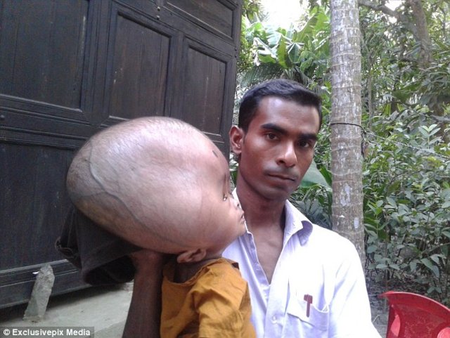 Bangladeş'te yaşayan minik Emon'un kafası tam 9 kilo