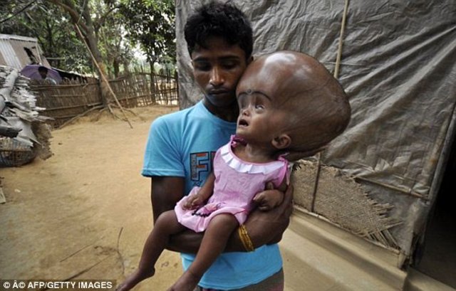 Bangladeş'te yaşayan minik Emon'un kafası tam 9 kilo