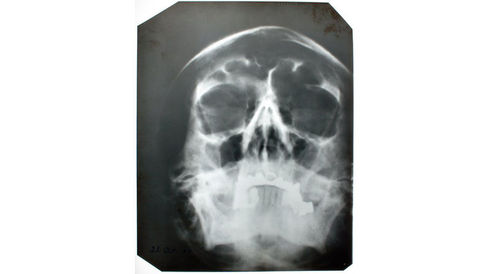 Hitler'in kafatası röntgeni
