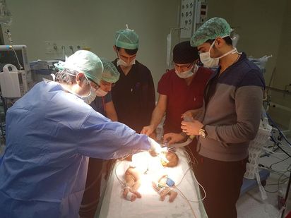 Siyam ikizlerinin ayrılması ameliyatını gerçekleştiren Çocuk Cerrahi Uzmanı Ali Suat Erkoç ve ekibi... 