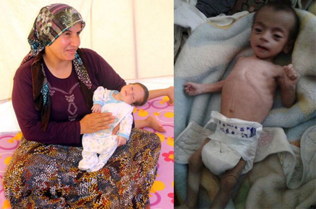Suriyeli minik Fatıma, dünyada nadir görülen hastalığı yendi