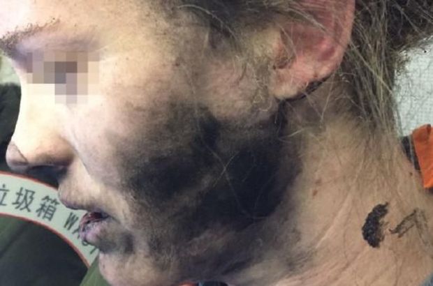 Avustralyalı talihsiz kadının kulağında pilli kulaklık patladı