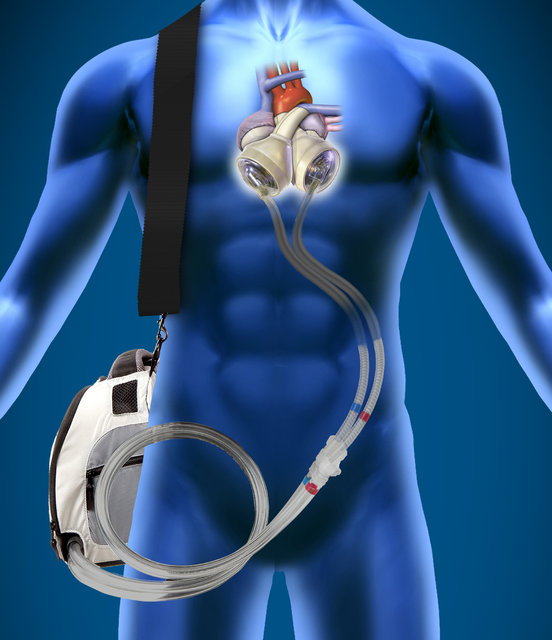 Robotik ve 3D baskı gelişmeleri ile yapay kalp gerçek olabilir