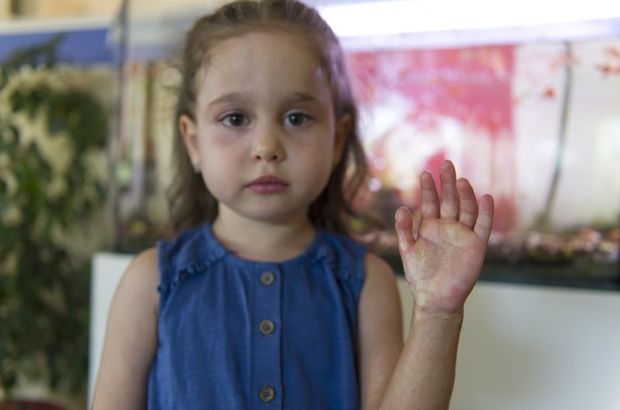 Türkiye'de ilk kez 3,5 yaşındaki bir çocuğa Skleroderma teşhisi konuldu