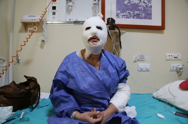 Erzurum'da patlayan düdüklü hastanelik etti