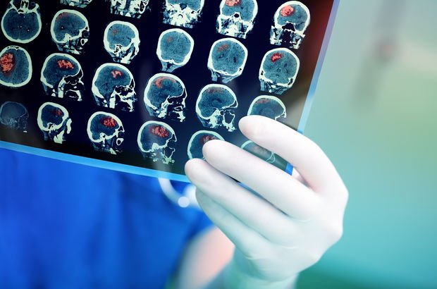 Yavuz Yılmaz'ın hastalığı temporal lob epilepsisi, beynin duyguları kontrol eden bölümünü etkiliyor!