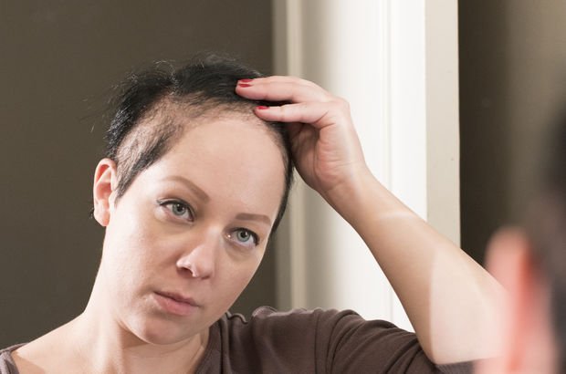 Kuaför olan trikotilomani hastası Kelsie Hanna saçlarını yolmadan bir gün bile geçiremiyor!
