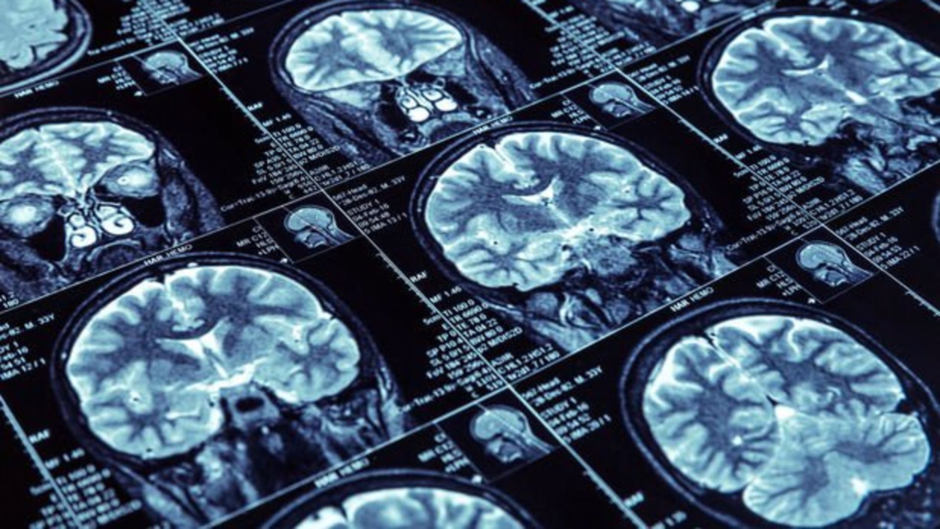 Epilepsi Neden Olur Epilepsi Neden Olur