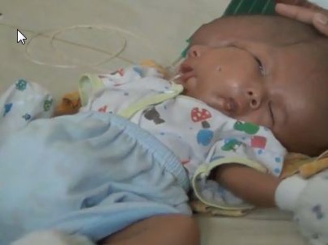 Endonezya'da iki yüzlü bebek doğdu!