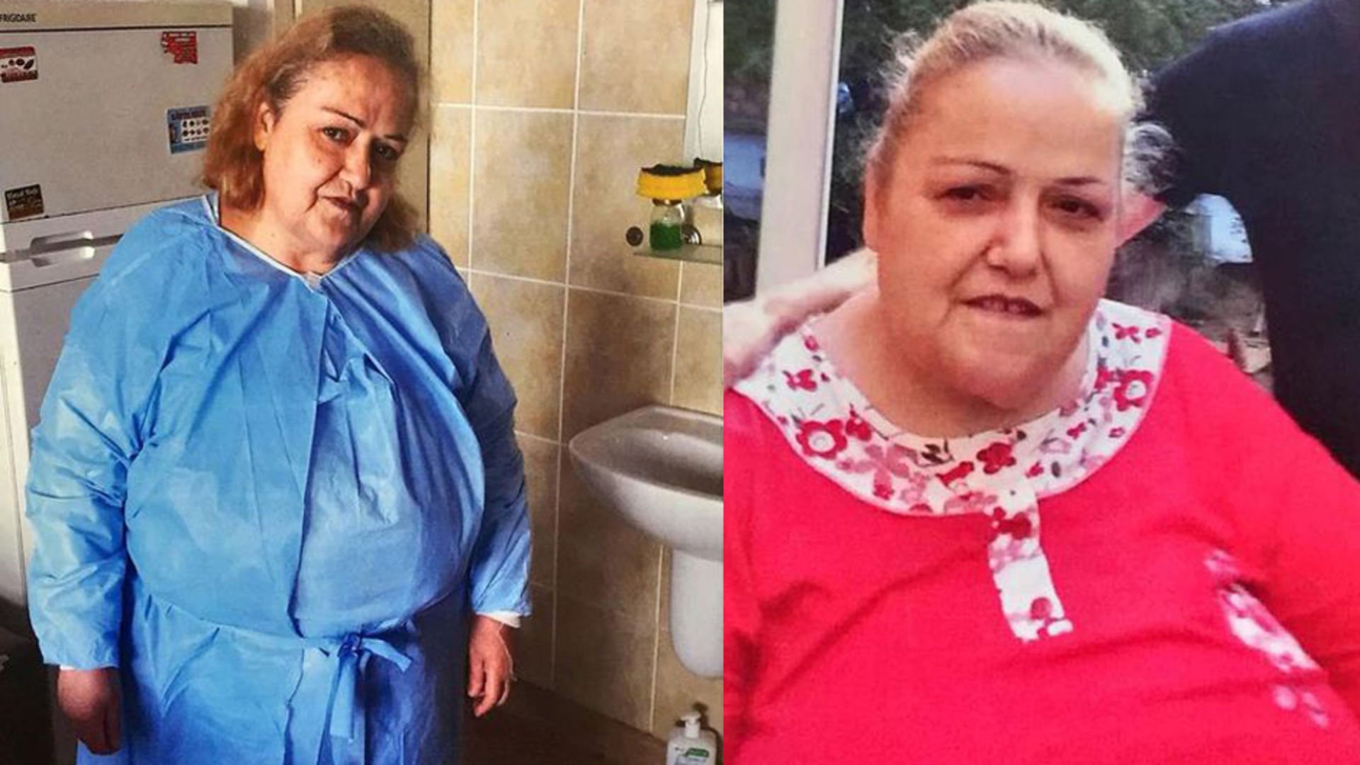 Mide Küçültme Ameliyatı Mide Küçültme Ameliyatı