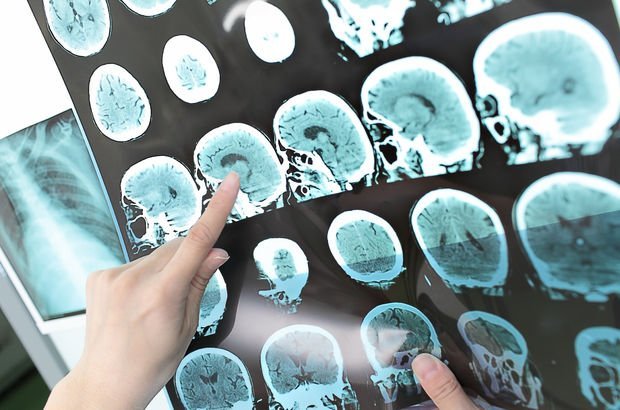 'Beyin piliyle Parkinson hastalığının saatini geri alıyoruz'