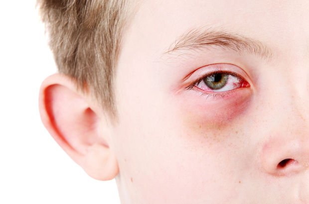 Göz alerjisi belirtileri, nedenleri ve tedavisi nasıl yapılır?