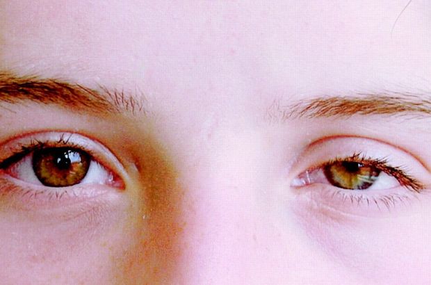 Göz kapağı düşüklüğü nedir? Göz kapağı düşüklüğü tedavisi