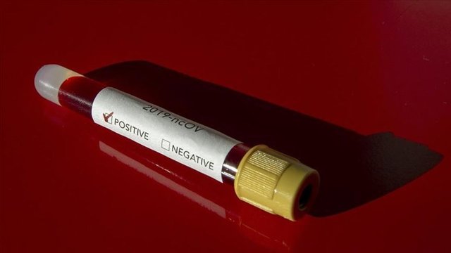 Son Dakika! Koronavirüsün başka belirtileri ortaya çıktı! Corona virüs belirtileri neler? - Haberler