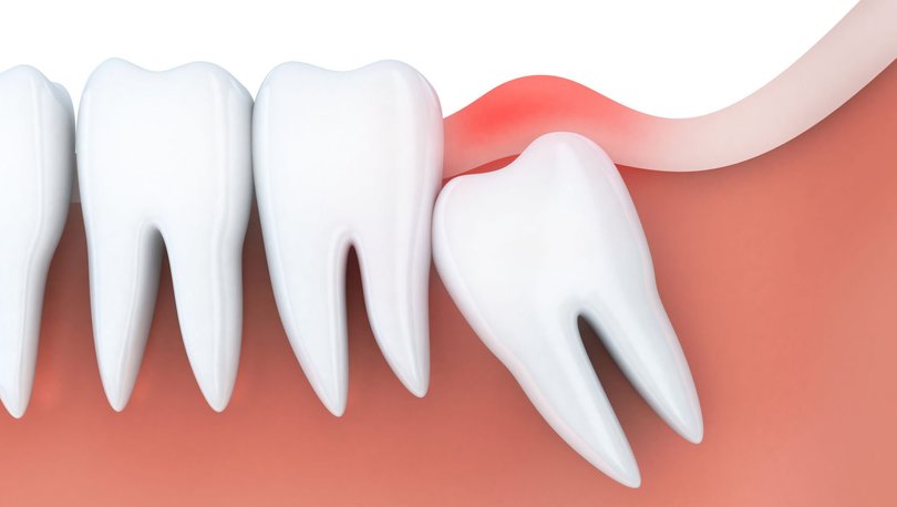 20’lik diş çekimi sonrasında ağrı ve şişlik ne kadar sürer? Ne Yenmeli?