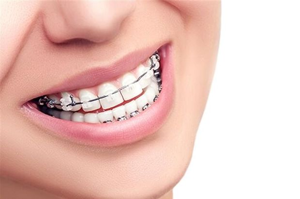 Ortodontik tedavilerde diş teli çeşitleri