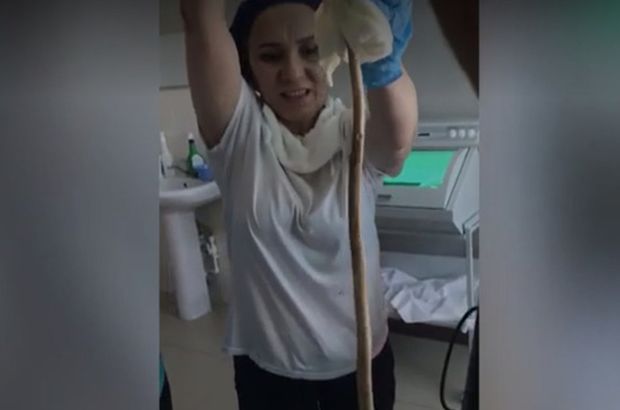 Rusya'da uyuyan kadının ağzından giren yılan ameliyatla böyle çıkarıldı!