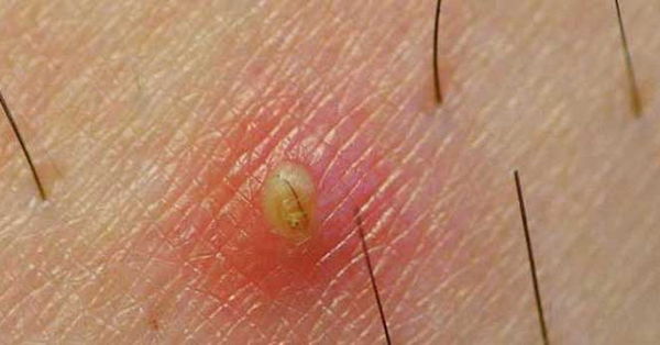 Kil Donmesi Nedir Sebepleri Belirtileri Ve Tedavi Yontemleri Nelerdir