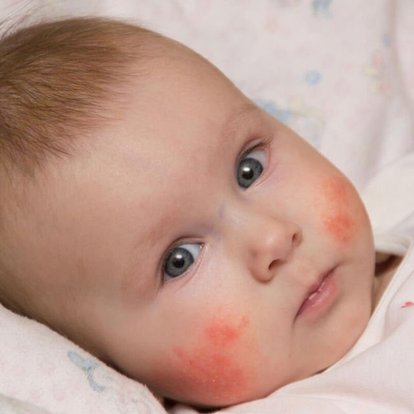bebeklerde alerji nedir alerji belirtileri nelerdir alerji tedavi yontemleri