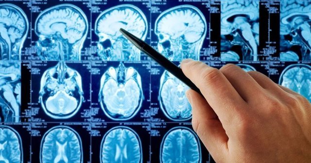 Beyni erken yaşlandıran 6 önemli tehlikeye dikkat! - Haberler