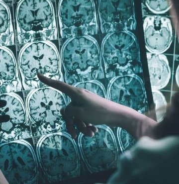 Nöroloji Uzmanı Prof. Dr. Lütfü Hanoğlu, "Son araştırmalar yaşam tarzının Alzheimer hastalığının gelişimindeki rolünün önemsenmediğini ve genetik risk faktörlerini de azaltabileceğini gösteriyor" dedi