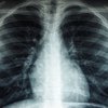 Düşük maliyetli bir ilacın Covid-19 hastalarında akciğer zararını sınırladığı belirlendi