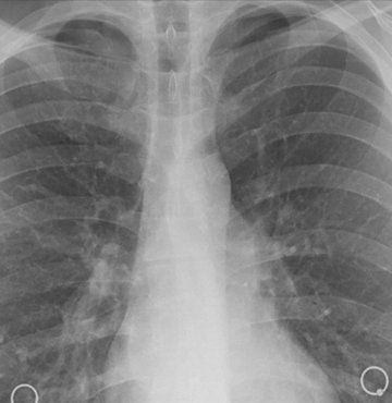 Türk Toraks Derneği Genel Başkanı Prof. Dr. İtil, Türkiye