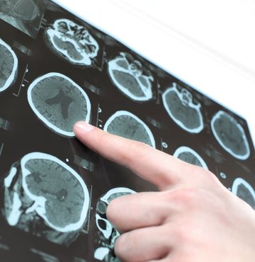 Nöroloji Uzmanı Dr. Oğuzhan Onultan, "Parkinson, hastaların yüzde 96’sı 50 yaş üstü olan, erkeklerde kadınlara göre 1,5 kat fazla görülen ve dünyada 10 milyon üstünde insanı etkilediği tahmin edilen sistemik bir hastalıktır" ifadesini kullandı