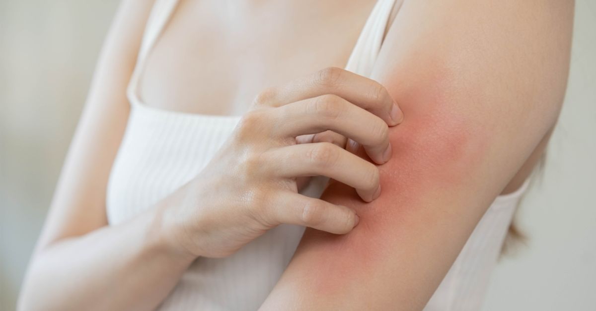 What Is Allergic Itching and Why Does It Happen?  How Allergic Itching Passes, What Are Its Symptoms?