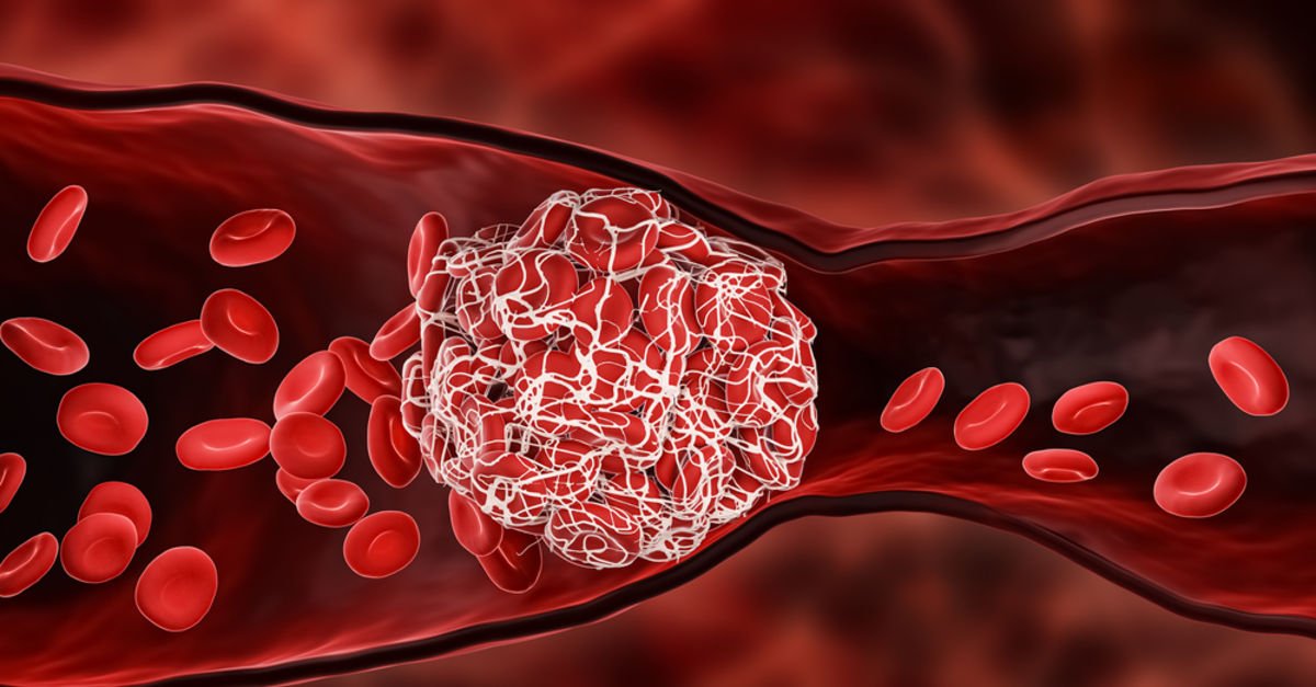 What Is A Clot In The Brain, Why Does It Happen? Archyworldys