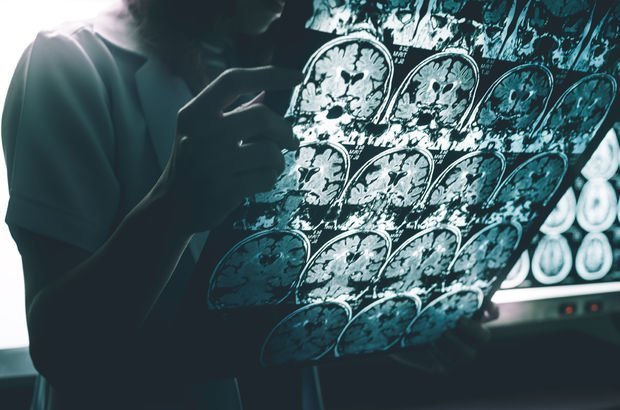 Covid-19, Alzheimer ve beyin kanaması riskini artırır mı?