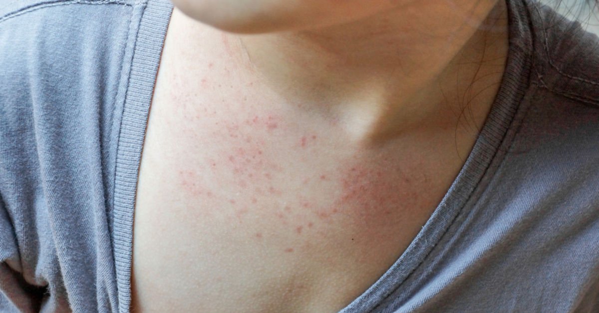 Gül Hastalığı Nedir, Neden Olur? Gül Hastalığı (Rozasea) Belirtileri ve ...