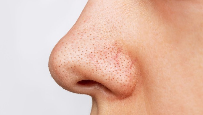 What Causes Blackheads, How Does It Go?  What Works Best for Blackheads?
