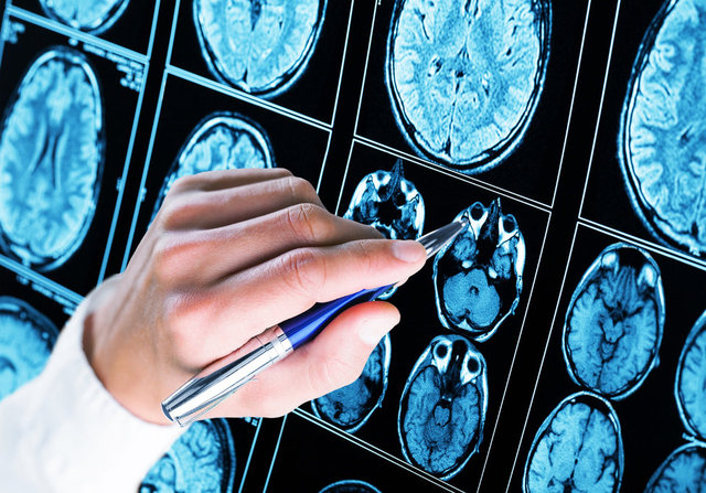 Bilim insanları beyin kanserine karşı implant geliştirdi!