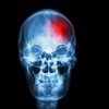 Parlak ışığa maruz kalmak migreni tetikliyor