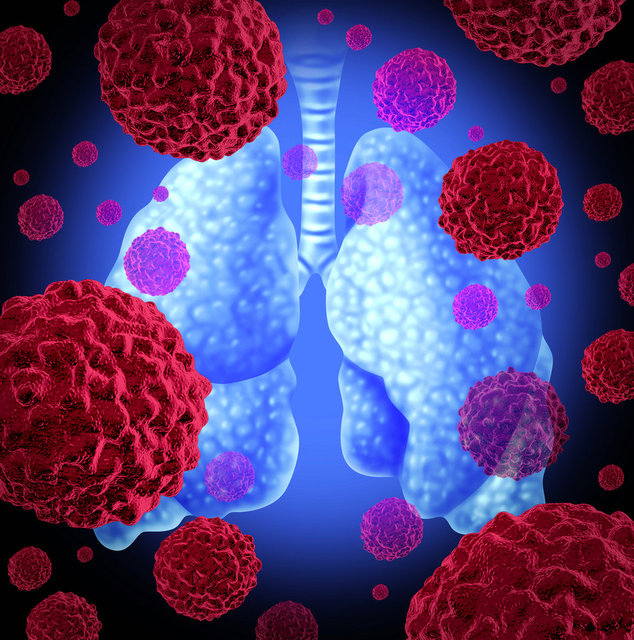 Akciğer kanserinin 8 önemli sinyaline dikkat!